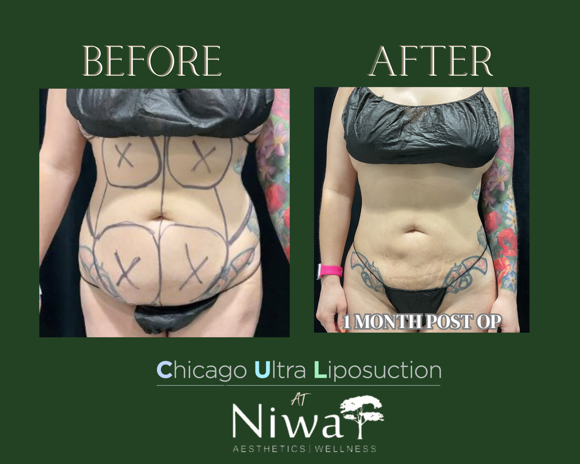 Liposuction