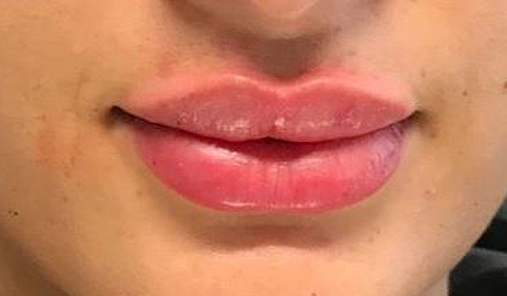 After Image: Lip Filler - front