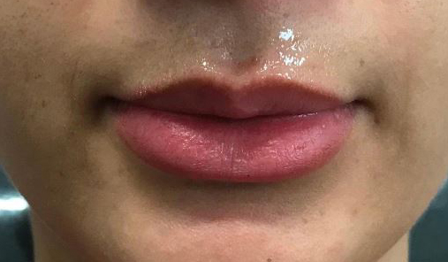 Before Image: Lip Filler - front