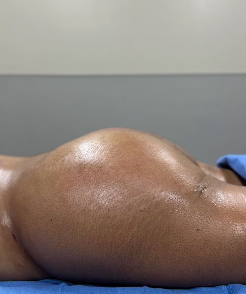 After Image: Lipo 360 and Fat Transfer to Buttocks - other