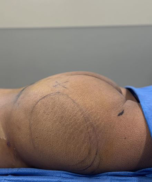 Before Image: Lipo 360 and Fat Transfer to Buttocks - other