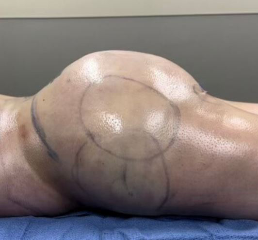 After Image: Lipo 360 and Fat Transfer to Buttocks - other