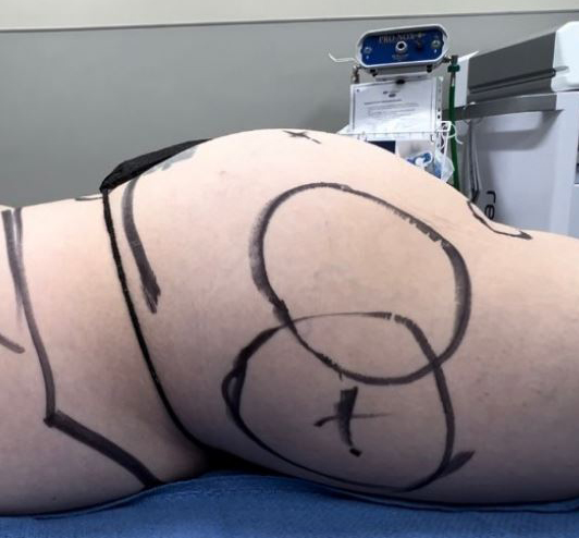Before Image: Lipo 360 and Fat Transfer to Buttocks - other