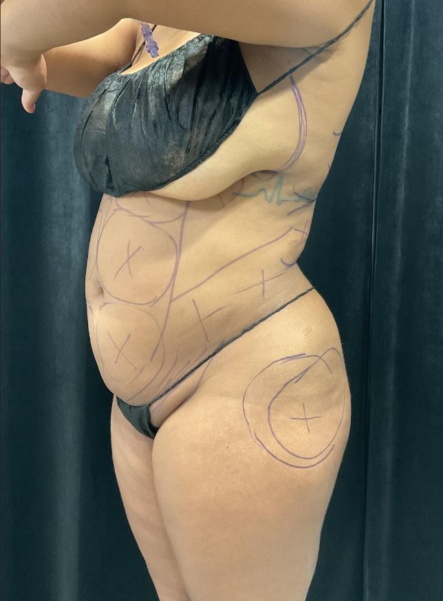 Before Image: Lipo 360 and Skin Tightening - left-front-oblique
