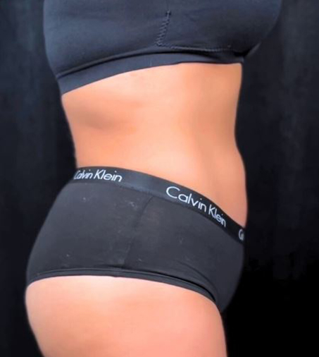 After Image: Lipo 360 and Skin Tightening - right-side