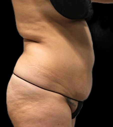 Before Image: Lipo 360 and Skin Tightening - right-side