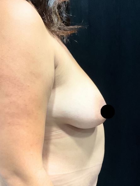 After Image: Lipo 360 and Skin Tightening with Fat Transfer to Breasts - right-side
