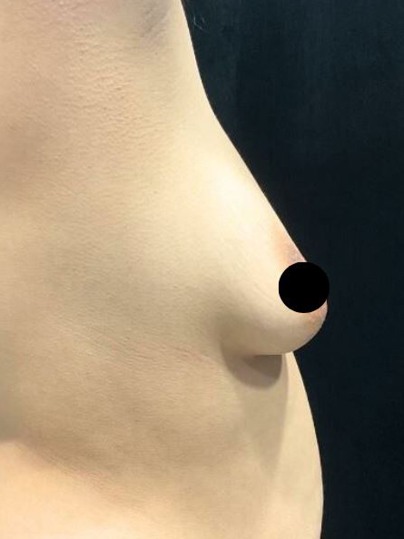 Before Image: Lipo 360 and Skin Tightening with Fat Transfer to Breasts - right-side