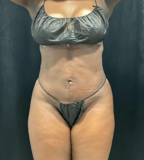 After Image: Lipo 360 and Skin Tightening - front
