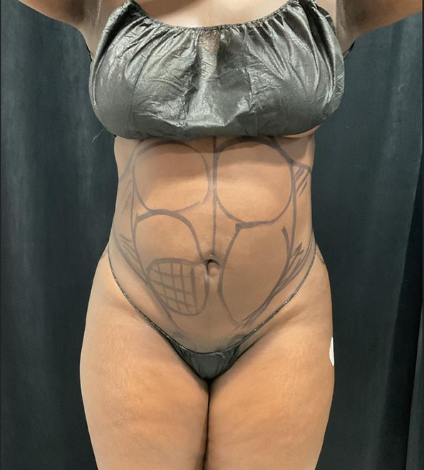 Before Image: Lipo 360 and Skin Tightening - front