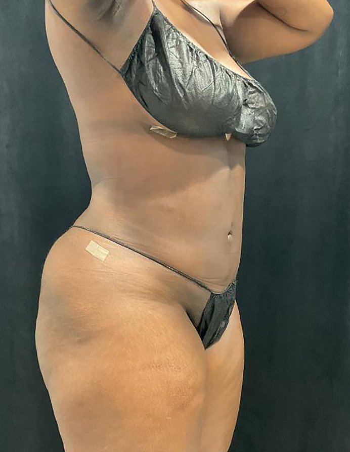 After Image: Lipo 360 and Skin Tightening - right-front-oblique
