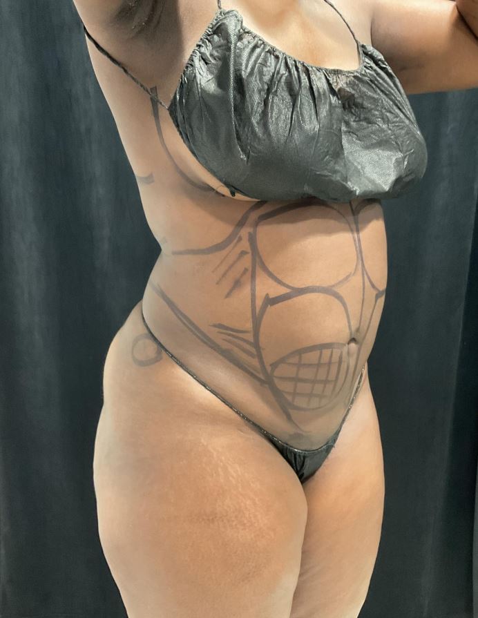 Before Image: Lipo 360 and Skin Tightening - right-front-oblique