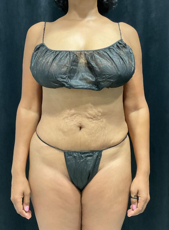 Before Image: Lipo 360 and Skin Tightening - front