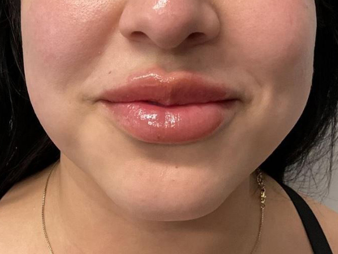 After Image: Lip Filler - front