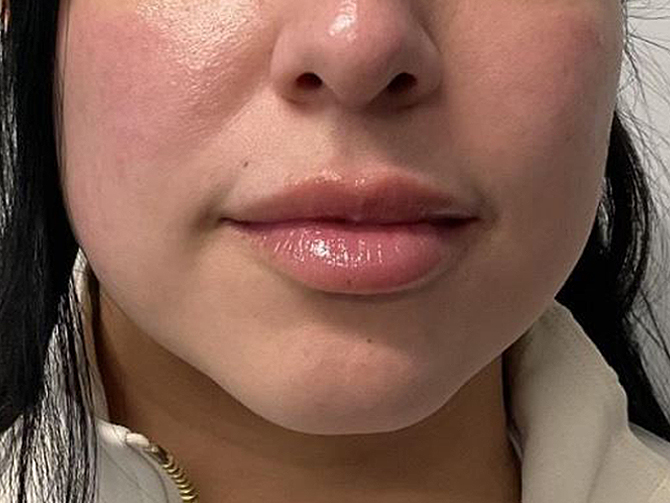 Before Image: Lip Filler - front