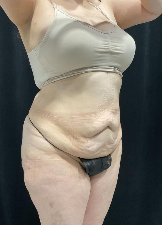 After Image: Lipo 360 and Skin Tightening - right-front-oblique
