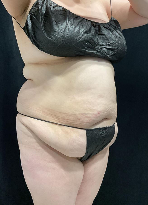 Before Image: Lipo 360 and Skin Tightening - right-front-oblique